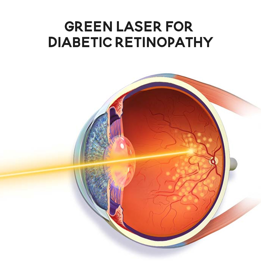 Green Laser For Diabetic Retinopathy