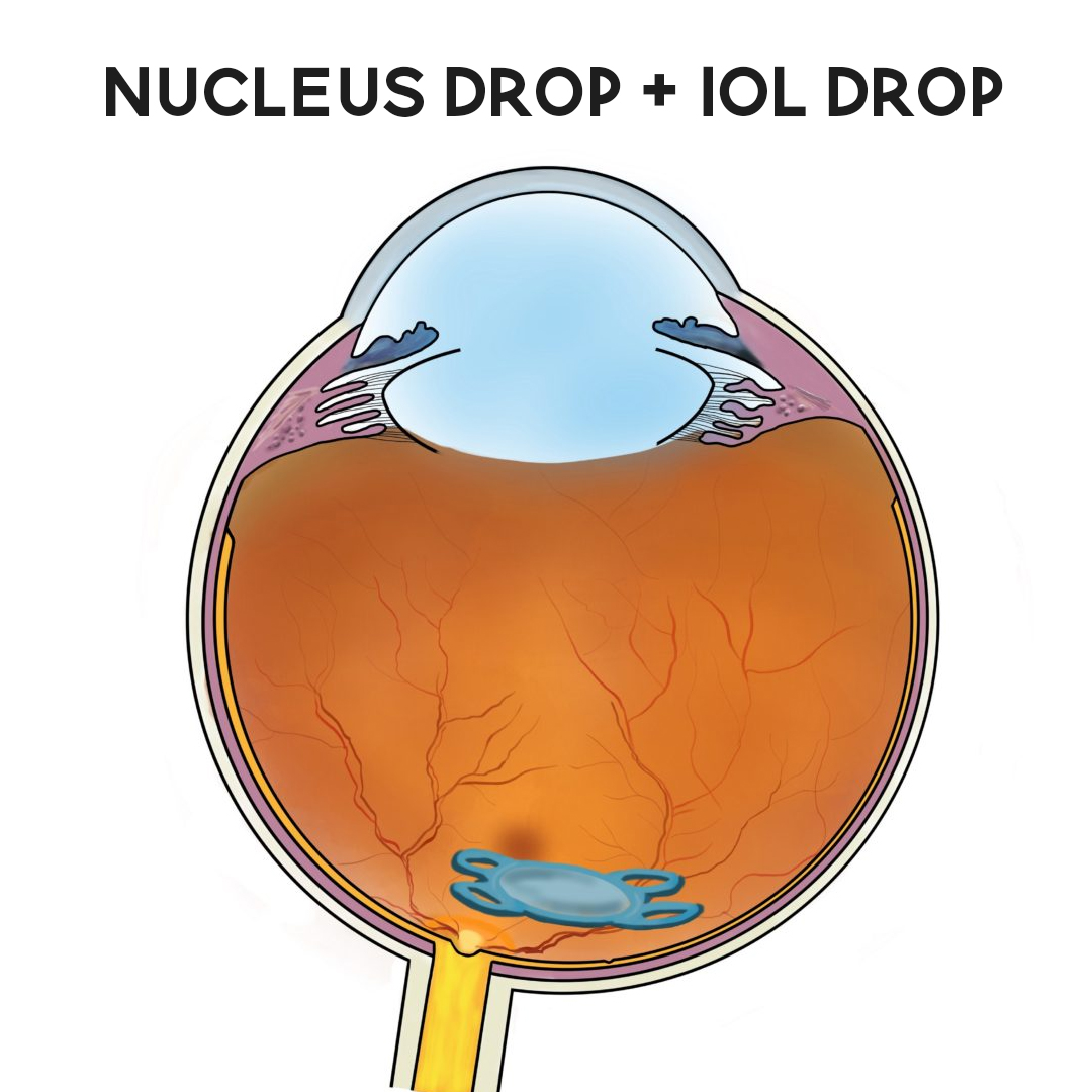 Nucleus Drop and Intraocular Lens (IOL) Drop - Dr. Harsh Inder Singh ...