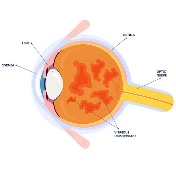 Vitreous Hemorrhage Treatment In Patiala Dr Harsh Inder Retina