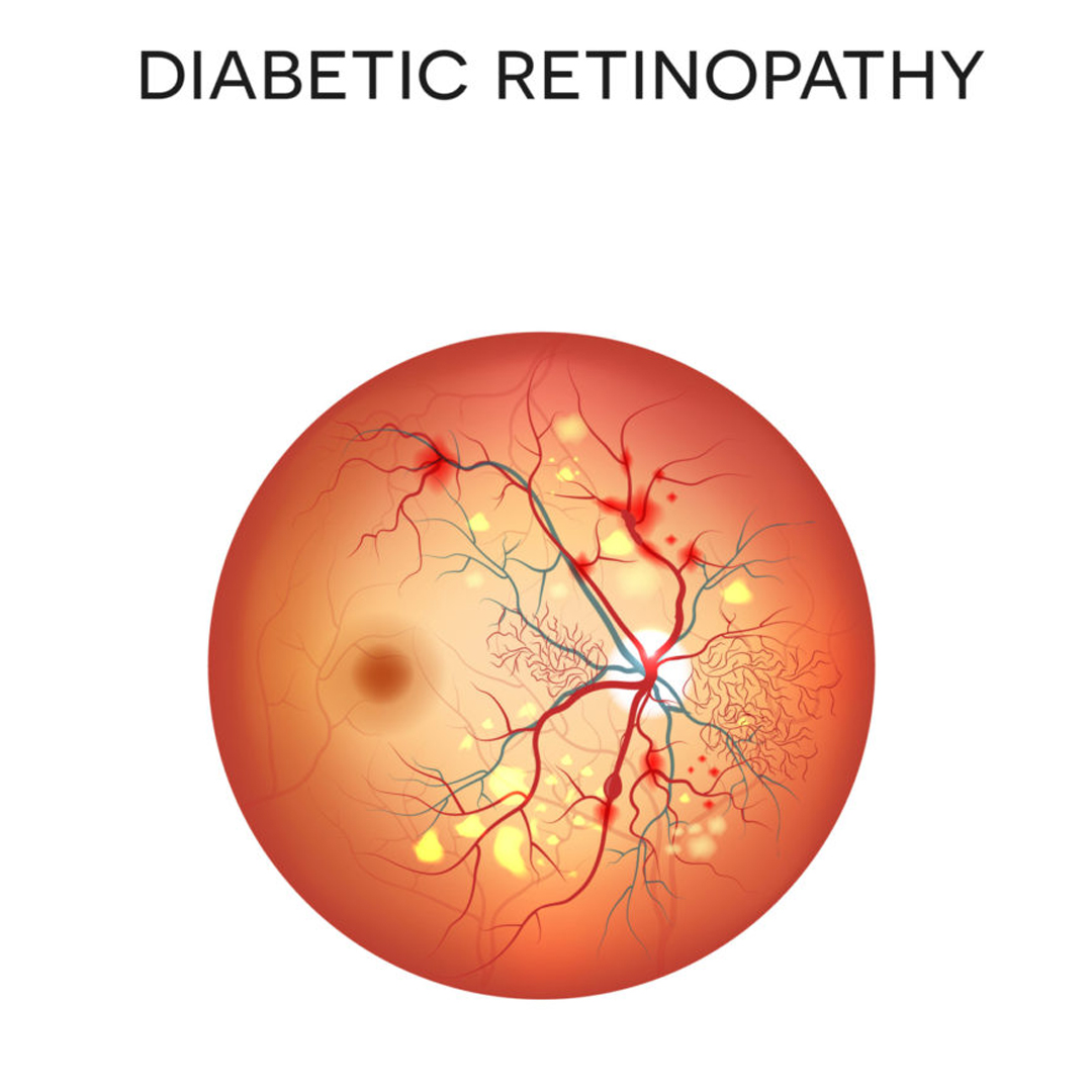 diabetic retinopathy 1