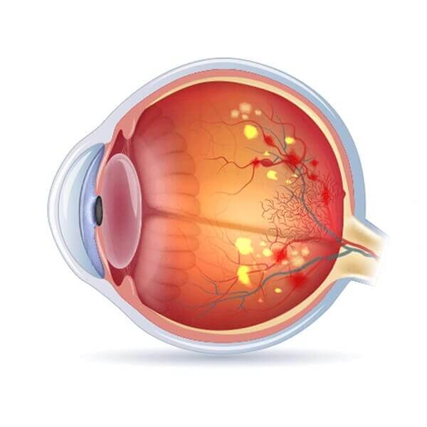 diabetic-retinopathy