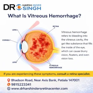 What Is Vitreous Hemorrhage